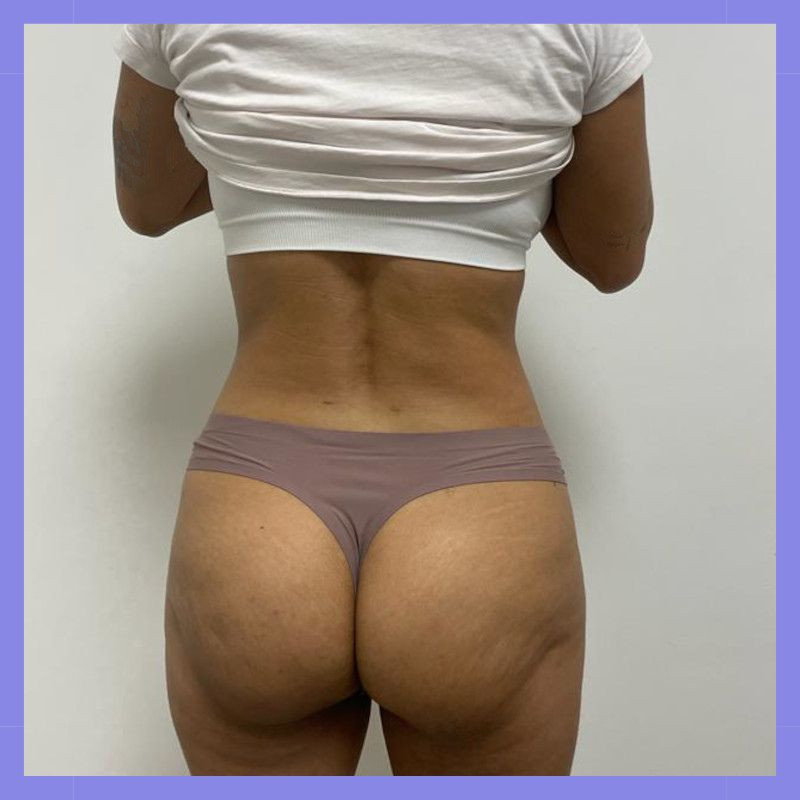 caso 23 exilis bl 12