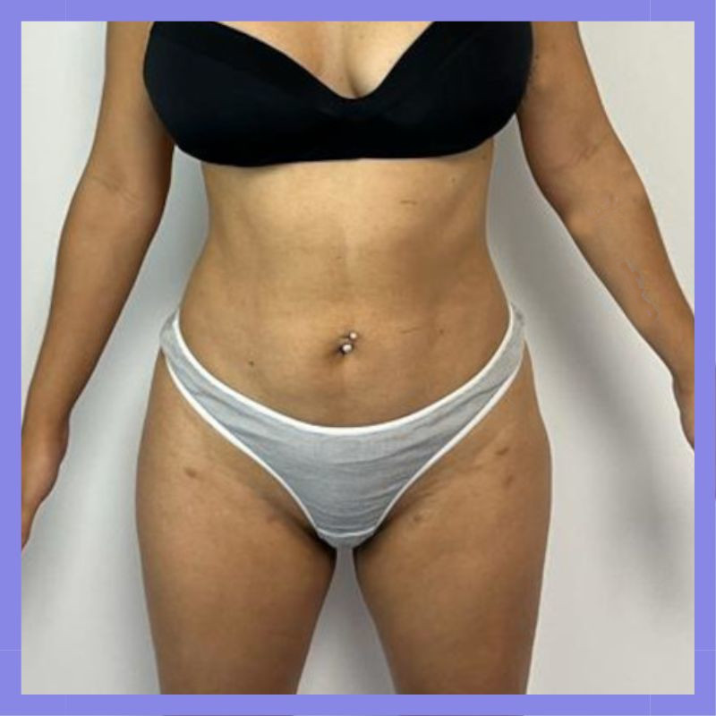 caso 23 exilis bl 4