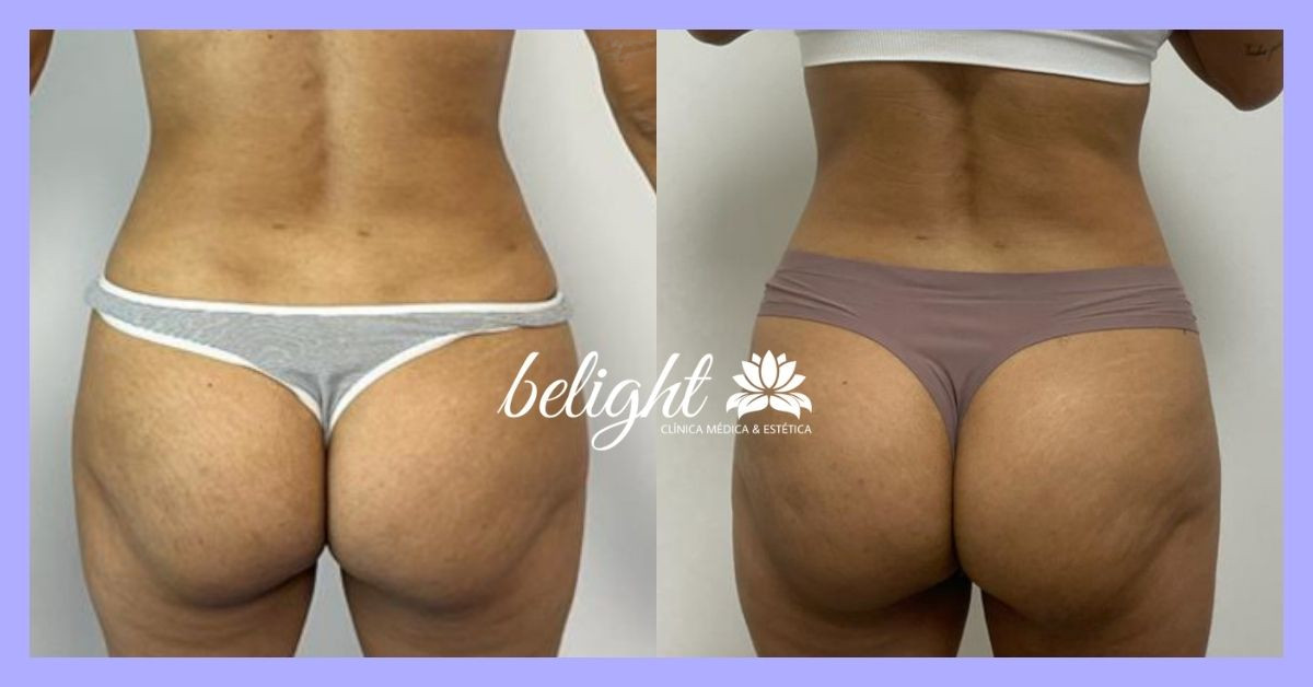 caso 23 exilis bl banner