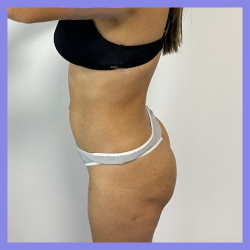 caso 23 exilis bl