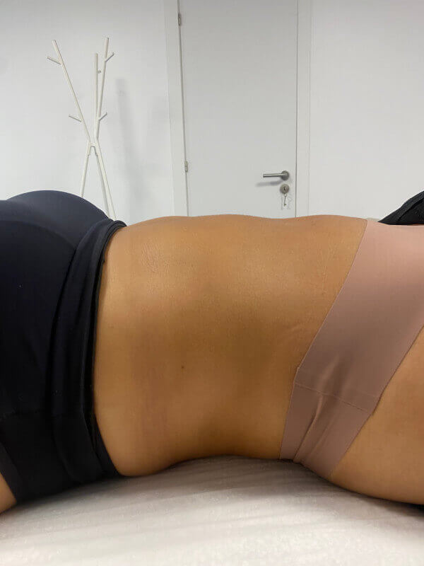 belight dlm antes depois 3