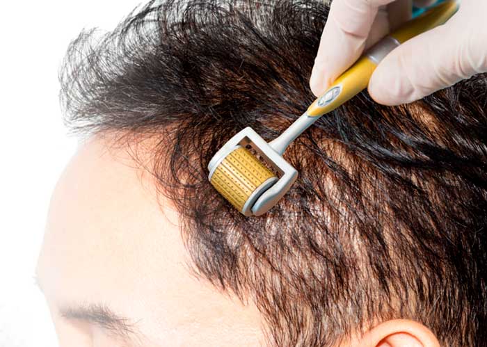 Dermaroller para alopecia